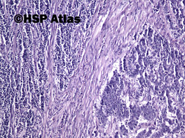 7. Mieszany rak gruczołowo - neuroendokrynny [Mixed adenoneuroendocrine carcinoma (MANEC)], 10x