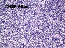 8. Mieszany rak gruczołowo - neuroendokrynny [Mixed adenoneuroendocrine carcinoma (MANEC)], 10x