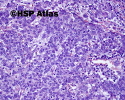 3. Rak rdzeniasty (medullary carcinoma)