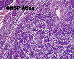 4. Rak rdzeniasty (medullary carcinoma)