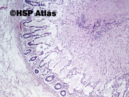 4. Pseudomembranous colitis, 4x