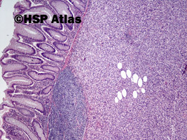 1. Mięśniakomięsak gładkokomórkowy okrężnicy (leiomyosarcoma), 4x