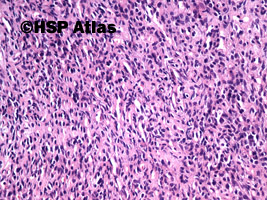 4. Samotny guz włóknisty (solitary fibrous tumor), 20x