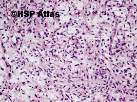 6. Samotny guz włóknisty (solitary fibrous tumor), 20x