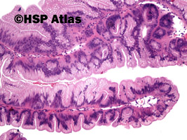 6. Tradycyjny gruczolak ząbkowany (traditional serrated adenoma), 10x