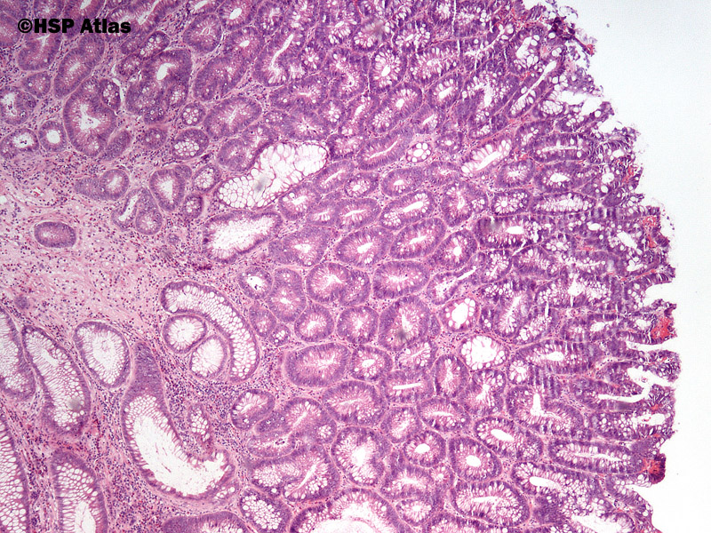adenoma tubulare mit jelent Krónikus prosztatitis férfiak meddősége