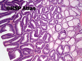4. Gruczolak cewkowo-kosmkowy (tubulovillous adenoma), 4x