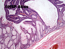 5. Gruczolak cewkowo-kosmkowy (tubulovillous adenoma), 4x