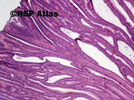 1. Gruczolak kosmkowy (villous adenoma), 4x
