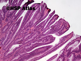 3. Gruczolak kosmkowy (villous adenoma), 4x