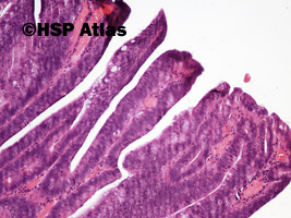 6. Gruczolak kosmkowy (villous adenoma), 10x