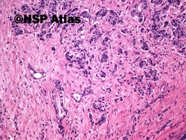 1. Rak przewodów żółciowych (cholangiocarcinoma), guz Klatskin'a, mężczyzna, 65 lat, 10x