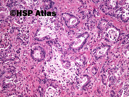 2. Rak przewodów żółciowych (cholangiocarcinoma), guz Klatskin'a, 10x
