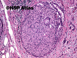 4. Rak przewodów żółciowych (cholangiocarcinoma), guz Klatskin'a, 10x