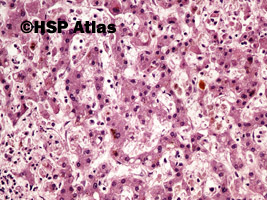 1. Cholestasis of liver, 20x
