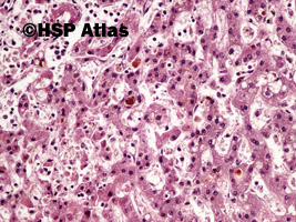 2. Zastój żółci (cholestasis of liver), 20x