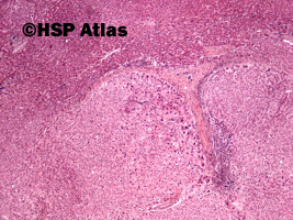1. Focal nodular hyperplasia, 4x