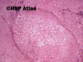 7. Focal nodular hyperplasia, 4x