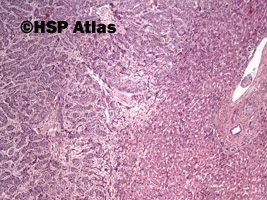 2. Rak wątrobowokomórkowy (hepatocellular carcinoma), 4x