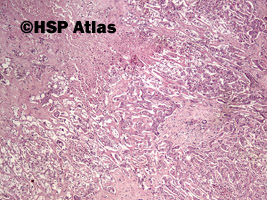 4. Rak wątrobowokomórkowy (hepatocellular carcinoma), 4x
