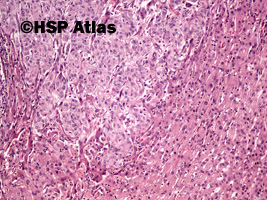 5. Rak wątrobowokomórkowy (hepatocellular carcinoma), 10x