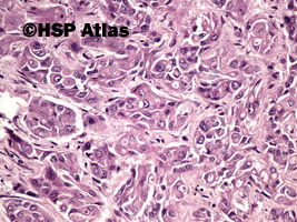 9. Rak wątrobowokomórkowy (hepatocellular carcinoma), 20x
