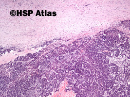 1. Wątrobiak zarodkowy (hepatoblastoma), 4x