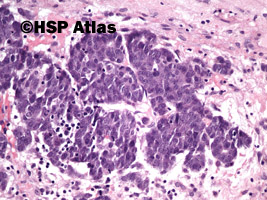 10. Wątrobiak zarodkowy (hepatoblastoma), 20x