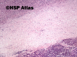 2. Wątrobiak zarodkowy (hepatoblastoma), 4x