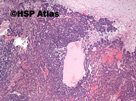 3. Wątrobiak zarodkowy (hepatoblastoma), 4x