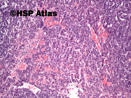 4. Wątrobiak zarodkowy (hepatoblastoma), 10x