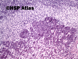 5. Wątrobiak zarodkowy (hepatoblastoma), 10x