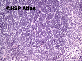 6. Wątrobiak zarodkowy (hepatoblastoma), 10x