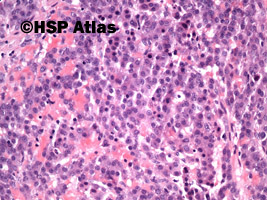 8. Wątrobiak zarodkowy (hepatoblastoma), 20x