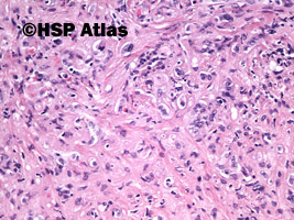 7. Myofibroblastyczny guz zapalny (inflammatory myofibroblastic tumor), 20x