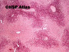 1. Martwica centrilobularna (martwica środkowej części zrazika), (centrilobular necrosis), 4x
