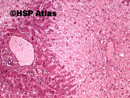 4. Martwica centrilobularna (martwica środkowej części zrazika), (centrilobular necrosis), 10x