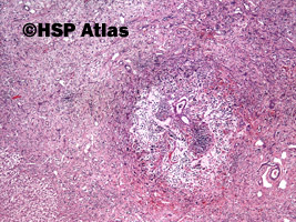 1. Przerzut neuroblastoma do wątroby (metastatic neuroblastoma), 4x