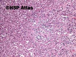 2. Przerzut neuroblastoma do wątroby (metastatic neuroblastoma), 10x