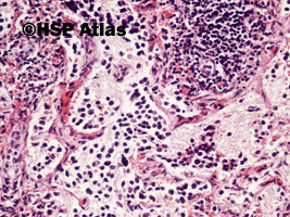 4. Przerzut neuroblastoma do wątroby (metastatic neuroblastoma), 20x