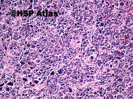 3. Przerzut raka dobnokomórkowego (metastatic small cell carcinoma), 10x