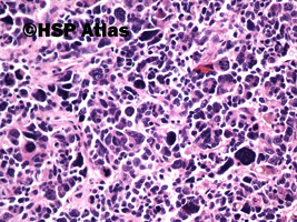 4. Przerzut raka dobnokomórkowego (metastatic small cell carcinoma), 20x