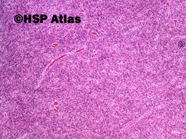 1. Gastrointestinal stromal tumor (GIST - epithelioid cell type), 4x