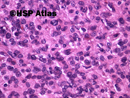 10. Gastrointestinal stromal tumor (GIST - epithelioid cell type), 40x