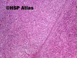 2. Nowotwór podścieliskowy przewodu pokarmowego - typ epitelioidny [gastrointestinal stromal tumor (GIST) - epithelioid cell type], 4x