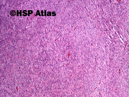3. Nowotwór podścieliskowy przewodu pokarmowego - typ epitelioidny [gastrointestinal stromal tumor (GIST) - epithelioid cell type], 4x