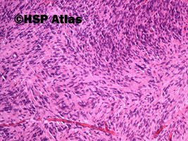 4. Gastrointestinal stromal tumor (GIST - epithelioid cell type), 10x