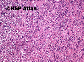 5. Gastrointestinal stromal tumor (GIST - epithelioid cell type), 10x
