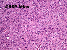 6. Gastrointestinal stromal tumor (GIST - epithelioid cell type), 10x