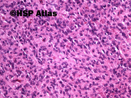 7. Gastrointestinal stromal tumor (GIST - epithelioid cell type), 20x